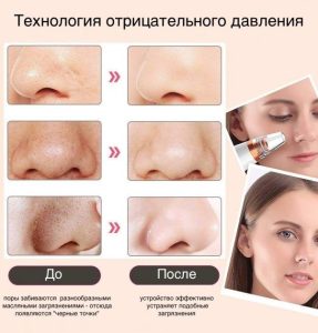 Вакуумный очиститель кожи и пор Multi-Functional для чистки лица — фото 2